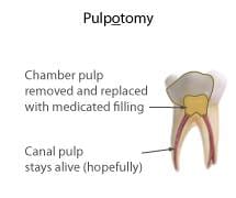 Tooth Pulp image